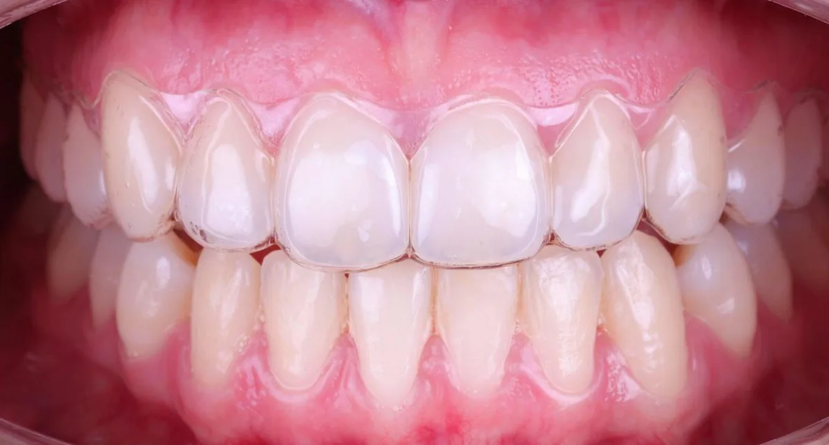 Alineador transparente colocado sobre los dientes