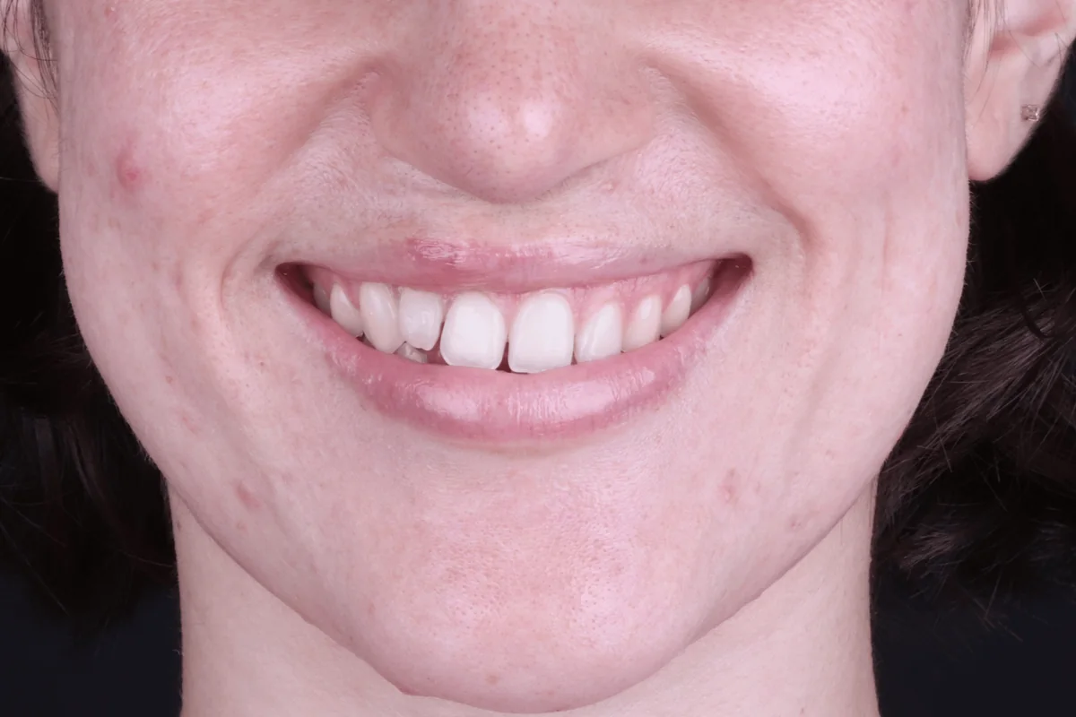 Caso 11, antes del tratamiento