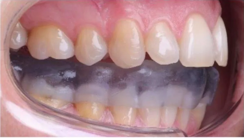 Férula oclusal para el tratamiento de la disfunción temporomandibular