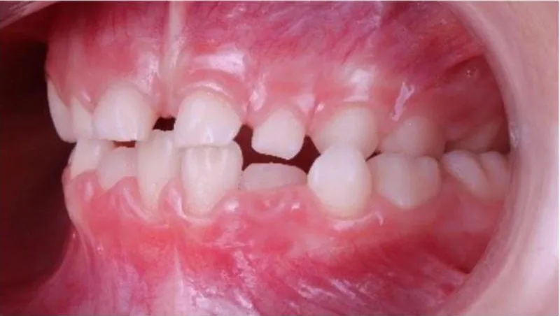 Dentición mixta de un niño: la ortopedia dentofacial guía el crecimiento de los maxilares